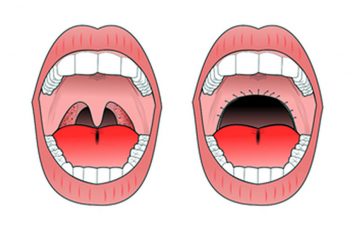 خطرات و عوارض جراحی زبان کوچک