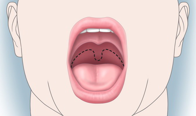 خطرات و عوارض جراحی زبان کوچک 
