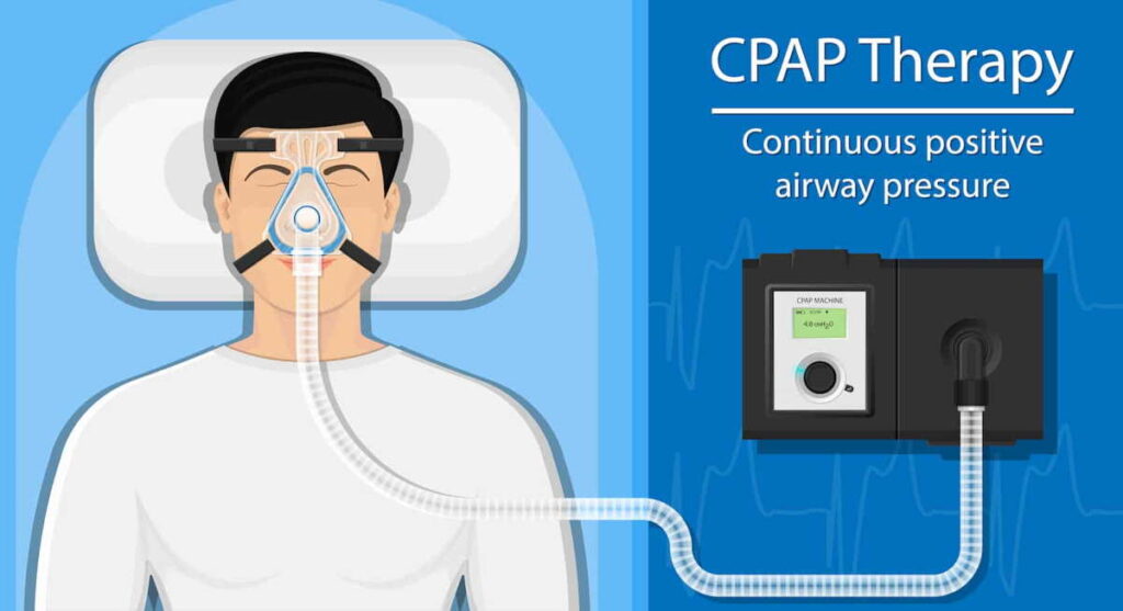 عوارض دستگاه سی پپ CPAP و جلوگیری از عوارض آن