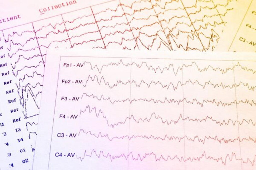 نوار مغز یا الکتروانسفالوگرام EEG؛ آمادگی ها و نتایج